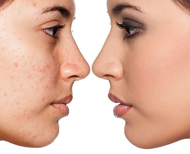 Skincare for Acne-Prone Skin: A Complete Guide to Clearer Skin.